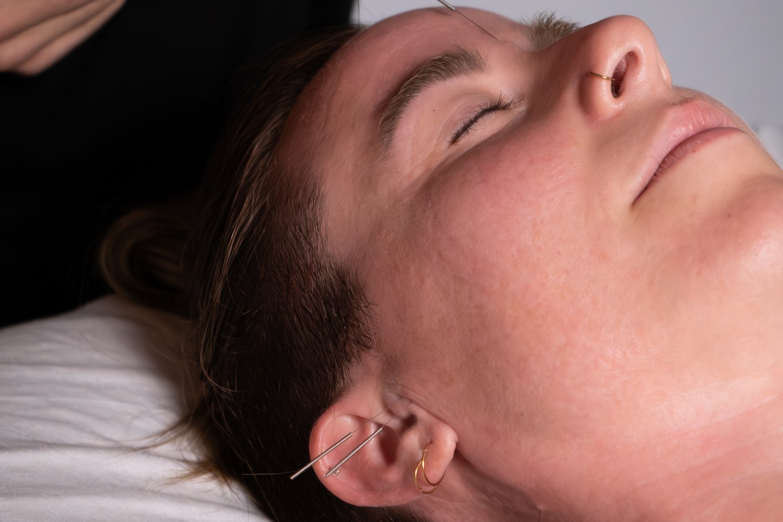 A patient relaxed during an Acupuncture facial, with fine needles placed around the ear and jaw