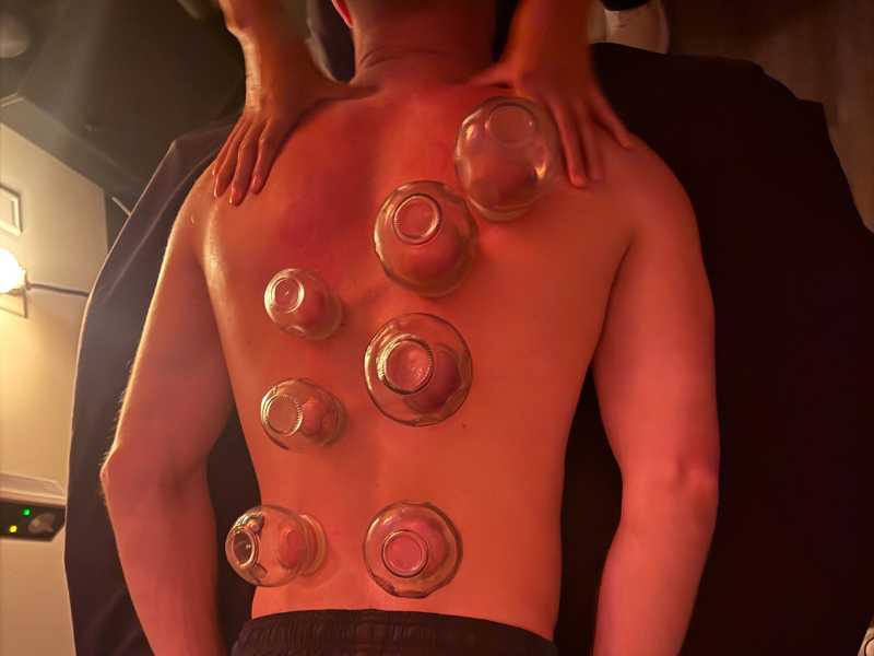 Fire cupping applied to an athlete’s back